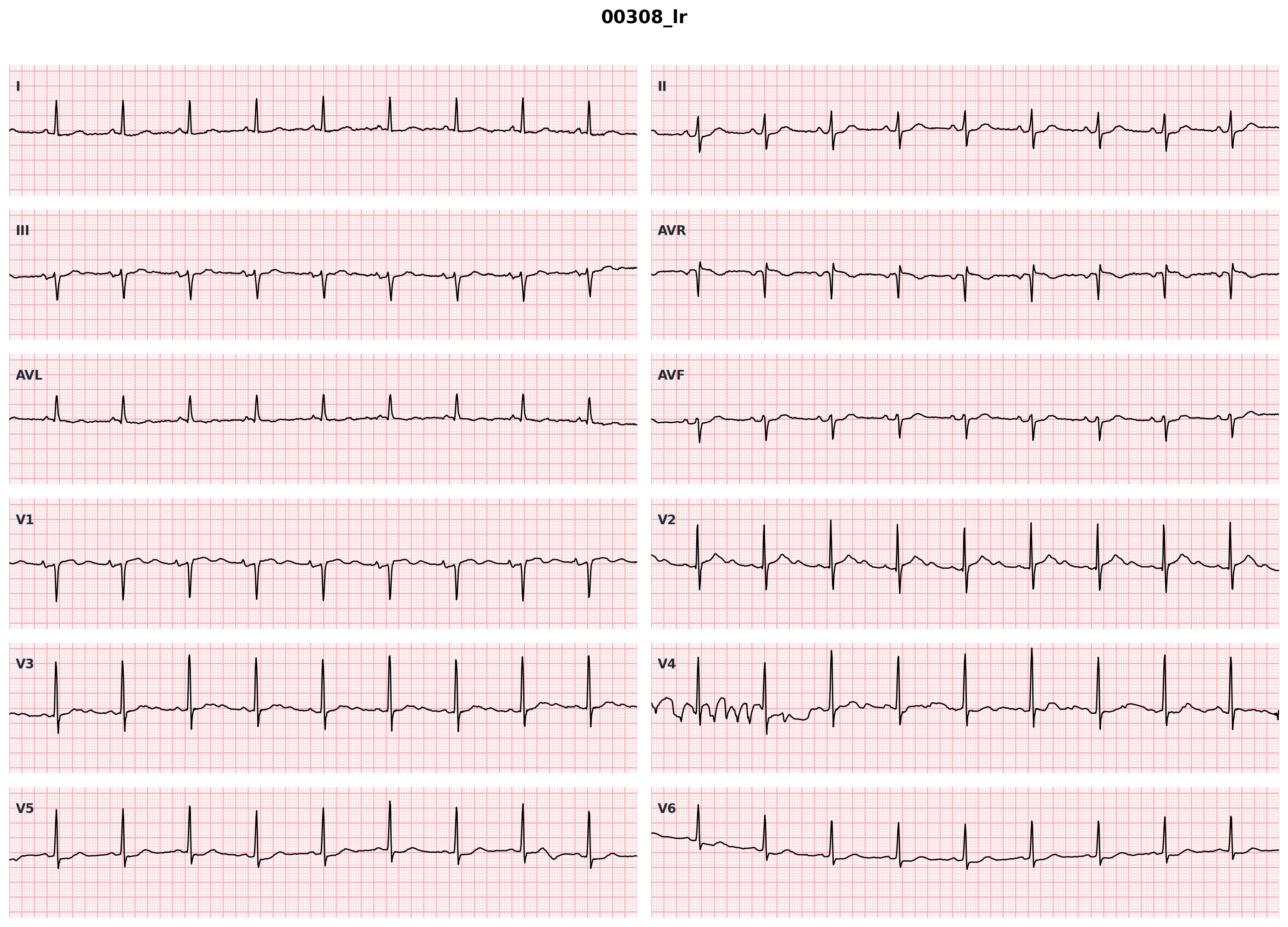 Anterior STEMI ECG